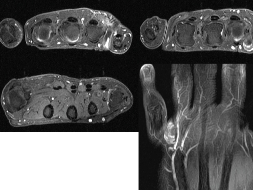 Figure 3 for case Venous malformation ( RID3337 )